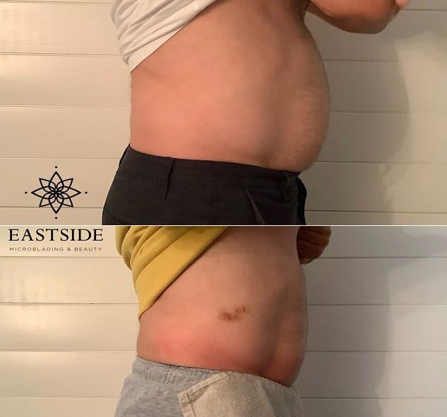 Body Contouring Scottsdale