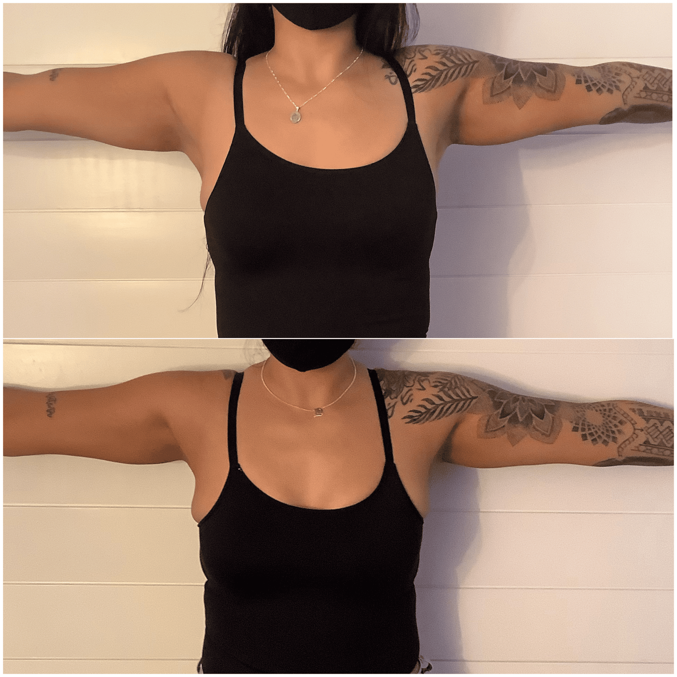 coolsculpting cryo effectiveness
