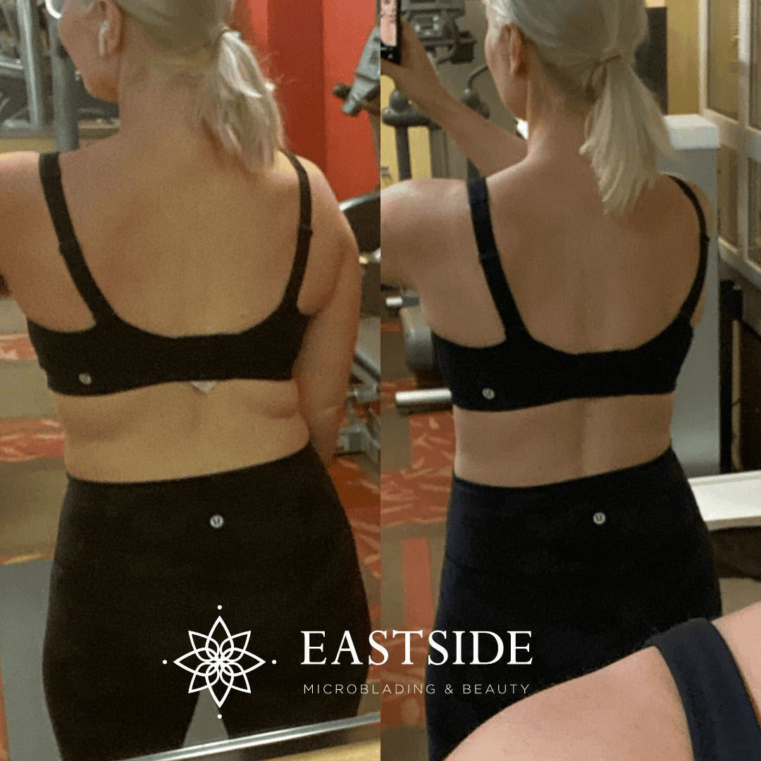 cryo before and after