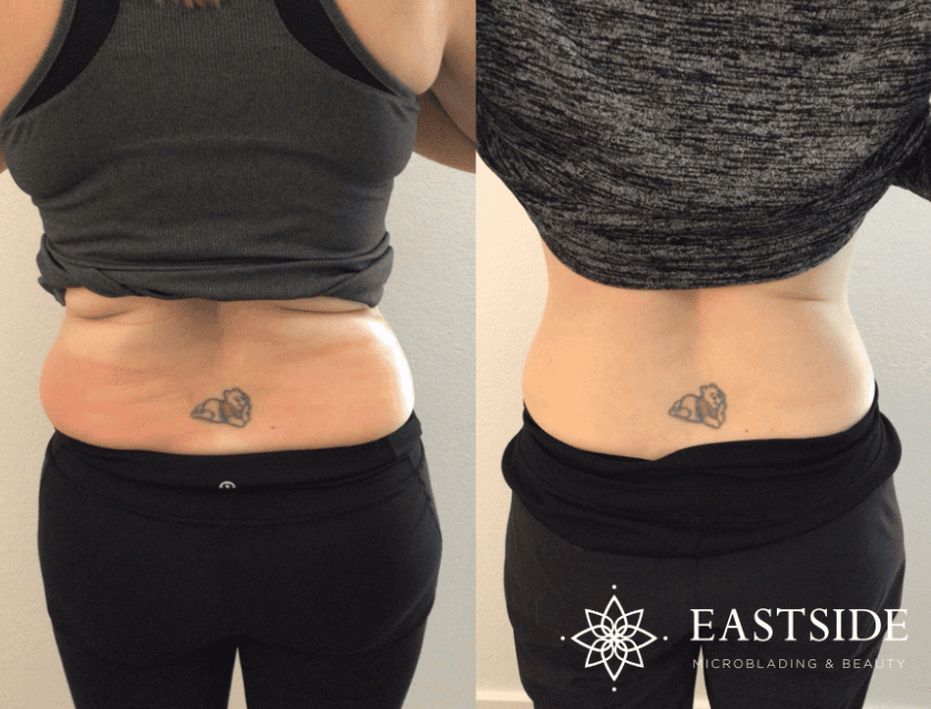 fat sculpting comparison